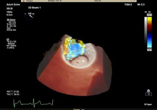 Heart Failure Echocardiography Registry